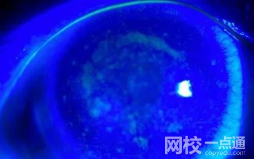 女子戴隱形10年角膜長滿新生血管 隨后被確診雙眼瞼緣炎結膜炎干眼癥