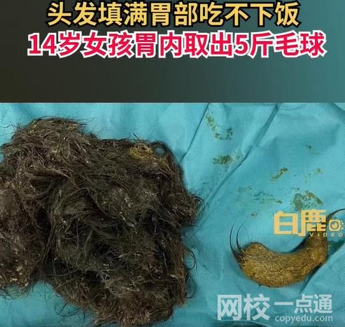 女孩吃頭發胃里取出5斤毛球 胃部已被“胃發石”填滿