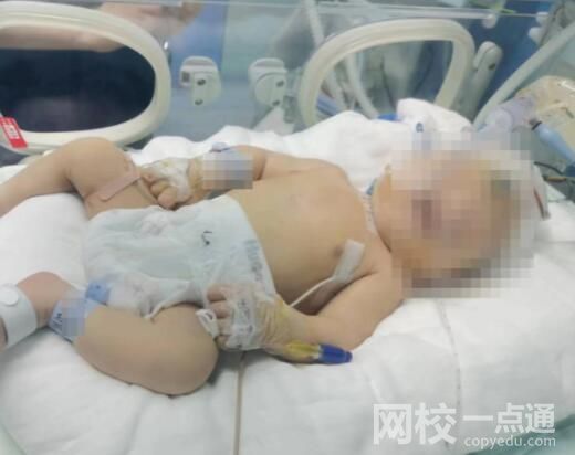 嬰兒出生后顱骨骨折 醫院回應:新生兒頭深陷骨盆