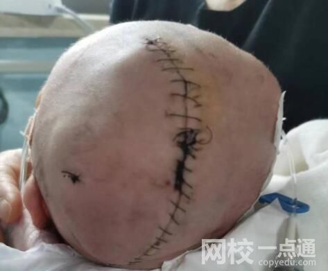 嬰兒出生后顱骨骨折 醫院回應:新生兒頭深陷骨盆