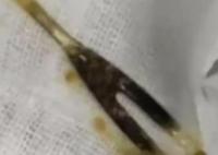 男子腹痛三月以為是腫瘤結(jié)果是叉子 到底是怎么進(jìn)去的？