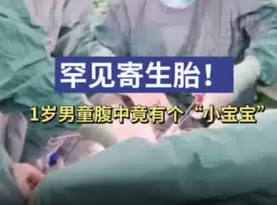 1歲男童腹中竟有個小寶寶 實在太罕見了