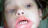 長哪吒同款鯊魚牙可能患有罕見病 究竟是什么樣的？