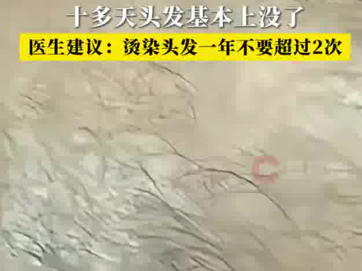 男子一月染頭4次致頭發大量脫落 實在太無奈了