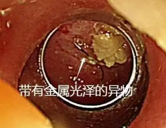 老人突發高燒拍胸片意外發現魚鉤 這也太恐怖了