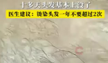 男子一月染頭4次致頭發大量脫落 實在太無奈了