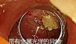 老人突發高燒拍胸片意外發現魚鉤 這也太恐怖了
