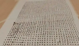 64歲大爺體內取出1791顆結石 這也太恐怖了
