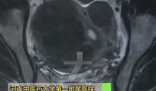 女子愛生悶氣子宮里長了8個瘤 實在太恐怖了