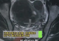 女子愛生悶氣子宮里長了8個(gè)瘤 實(shí)在太恐怖了