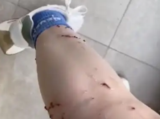 女子被寵物貓咬傷腿部潰爛 究竟是怎么回事？