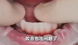 女子花6萬植12顆牙2年調試20多次 究竟是怎么回事？