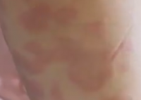 女孩打水光針全身過敏出紅斑 究竟是怎么回事？